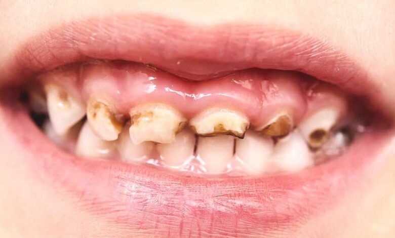 псуються зуби